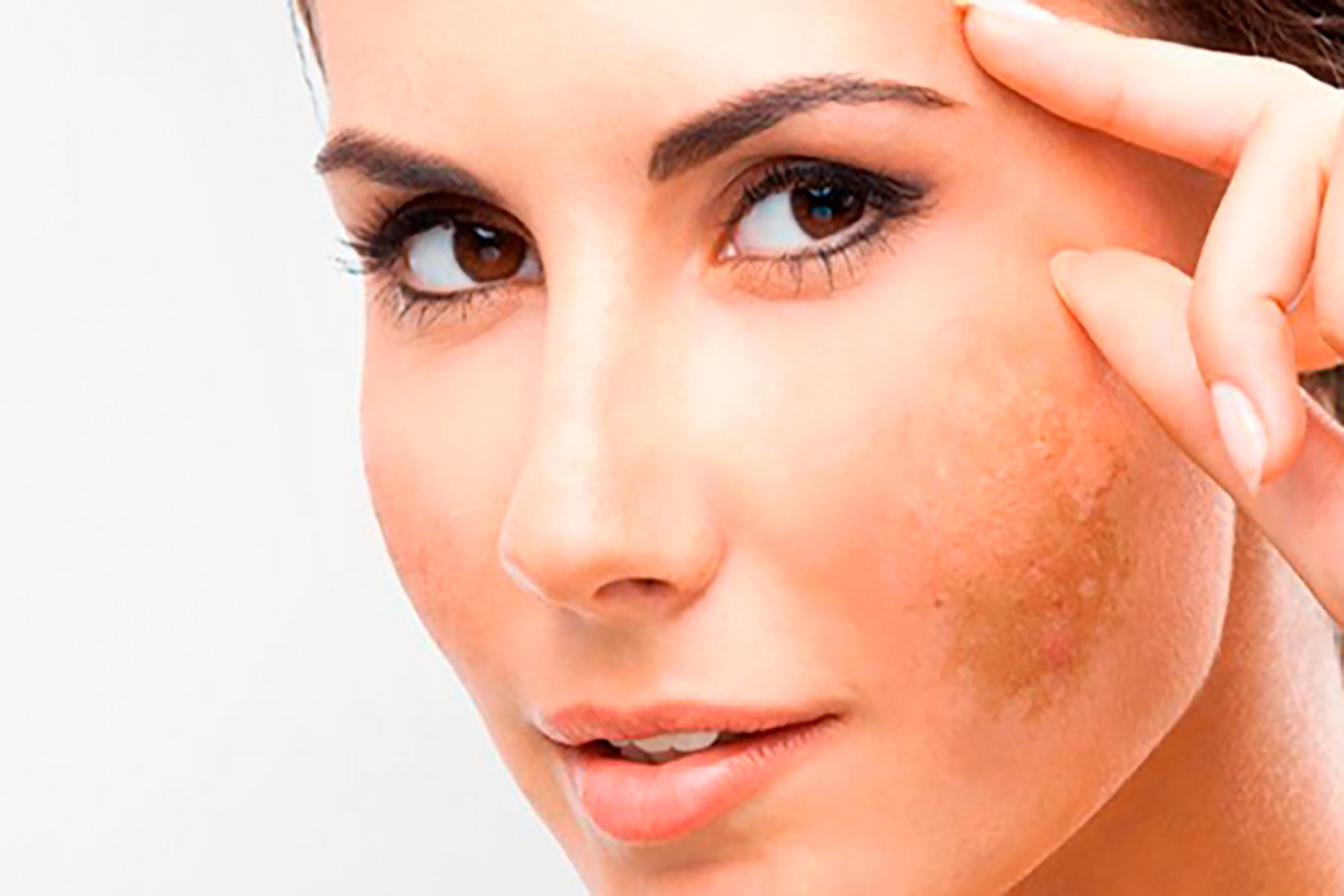 Leia mais sobre o artigo Tratamento de melasma