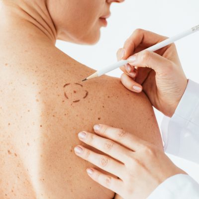 cropped view of dermatologist applying marks on skin of naked woman with melanoma isolated on white
