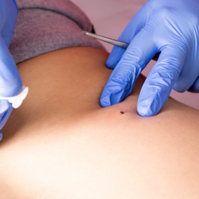Procedure removing mole using a medical laser