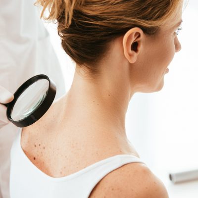 cropped view of dermatologist holding magnifying glass while examining woman with melanoma