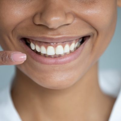 Close up african woman point finger at perfect straight hollywood white toothy smile.  After whitening dental treatment procedure showing result, health stomatology dentistry service, oralcare concept