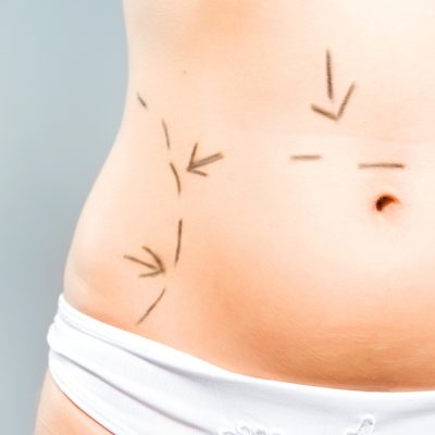 Closeup photo of a Caucasian woman's abdomen  marked with lines for abdominal cellulite correction cosmetic surgery